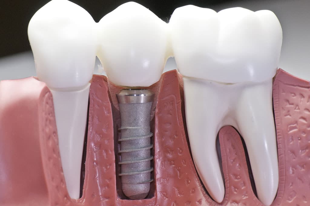 Dental Implants - Smiles for Everyone