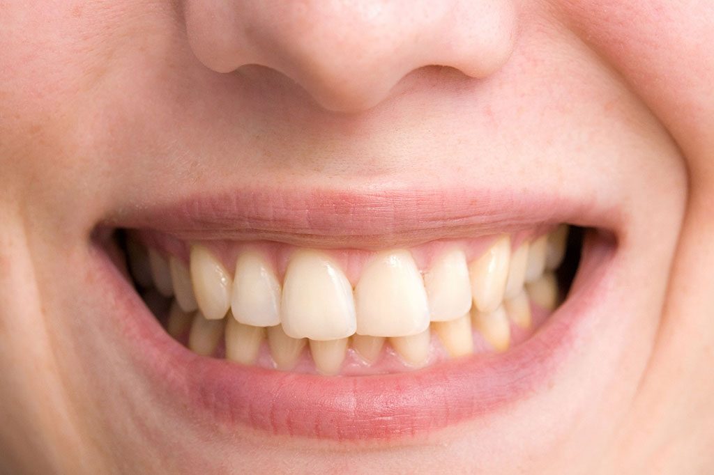 Dientes torcidos - Sonrisas para todos