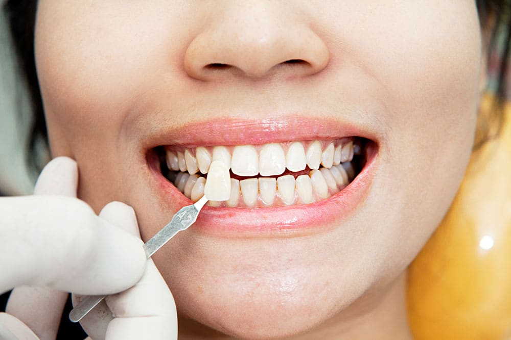 Veneers - Smiles for all