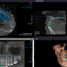 Imágen de una Tomografía Dental