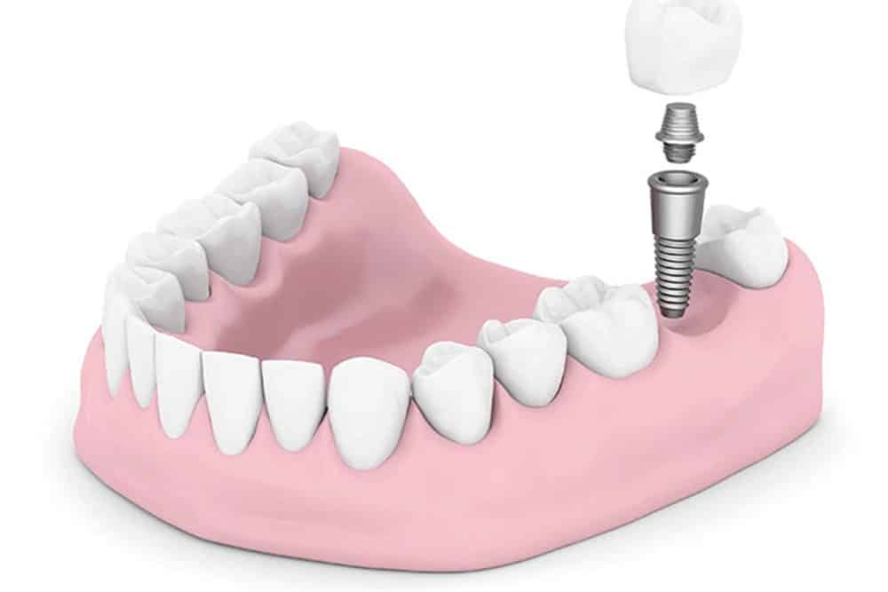 Tratamiento de Implantes dentales