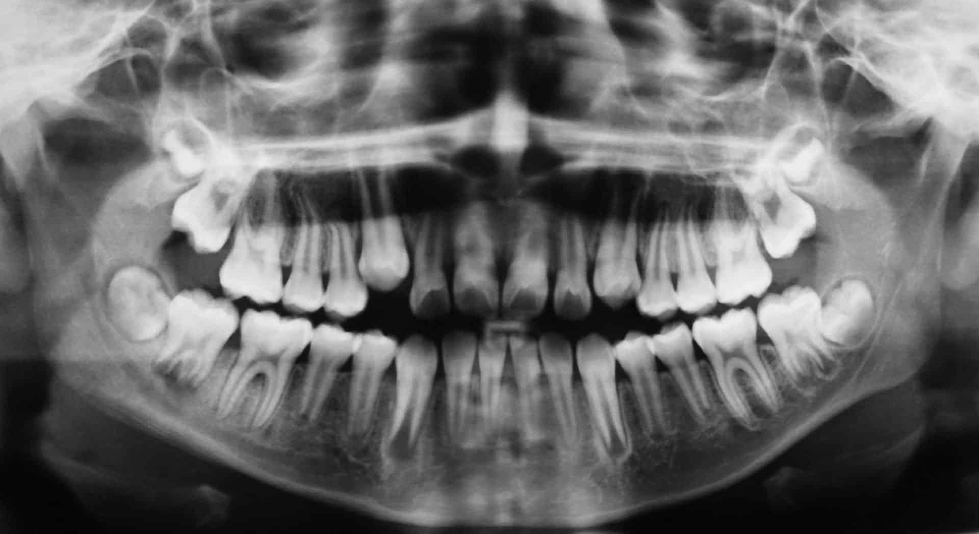 Radiografia Panoramica Costa Rica Sonrisa Para Todos Dentistas