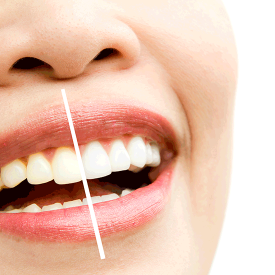 Dental esthetics