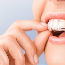 invisalign-bannar