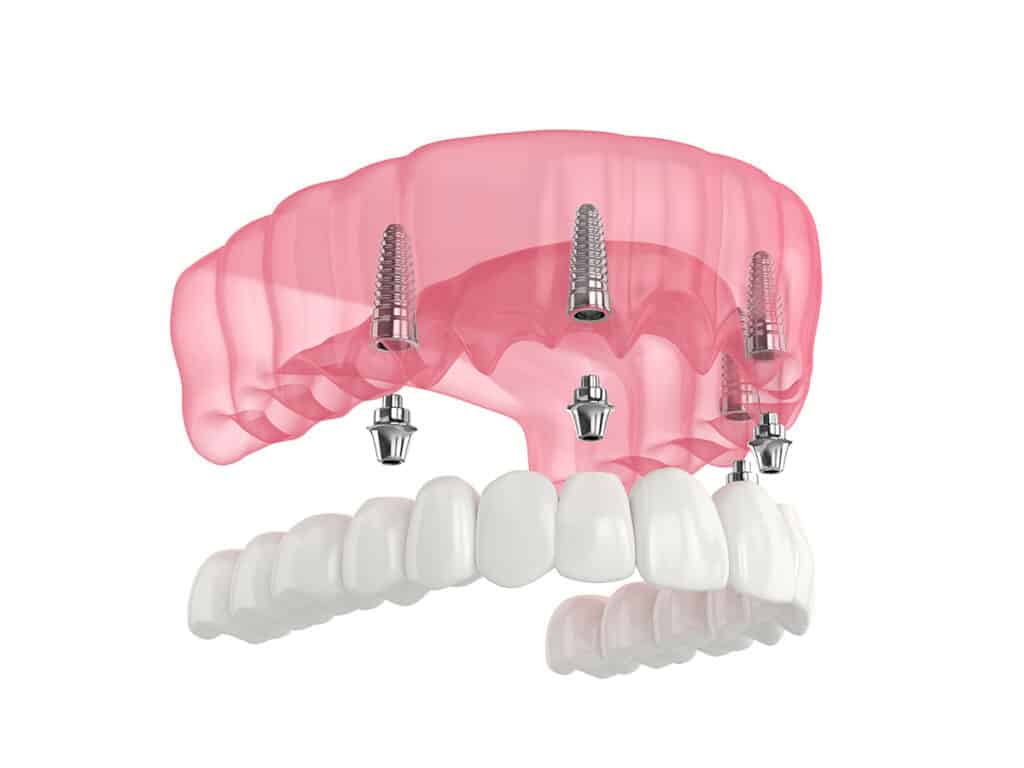 All on 4 Dental Implants in Costa Rica