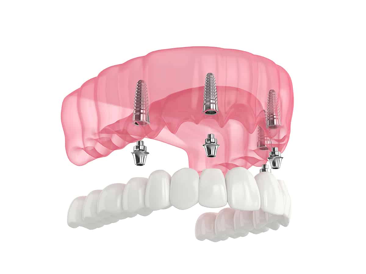 All on 4 Dental Implants in Costa Rica