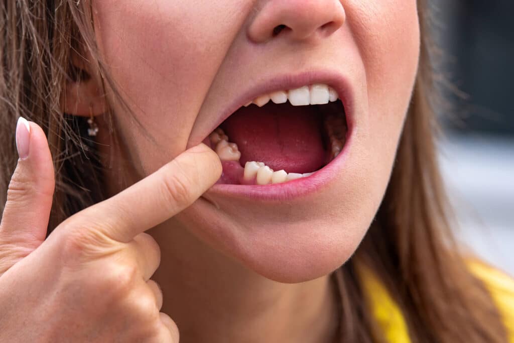 Tratamiento protésico fijo sobre implantes dentales
