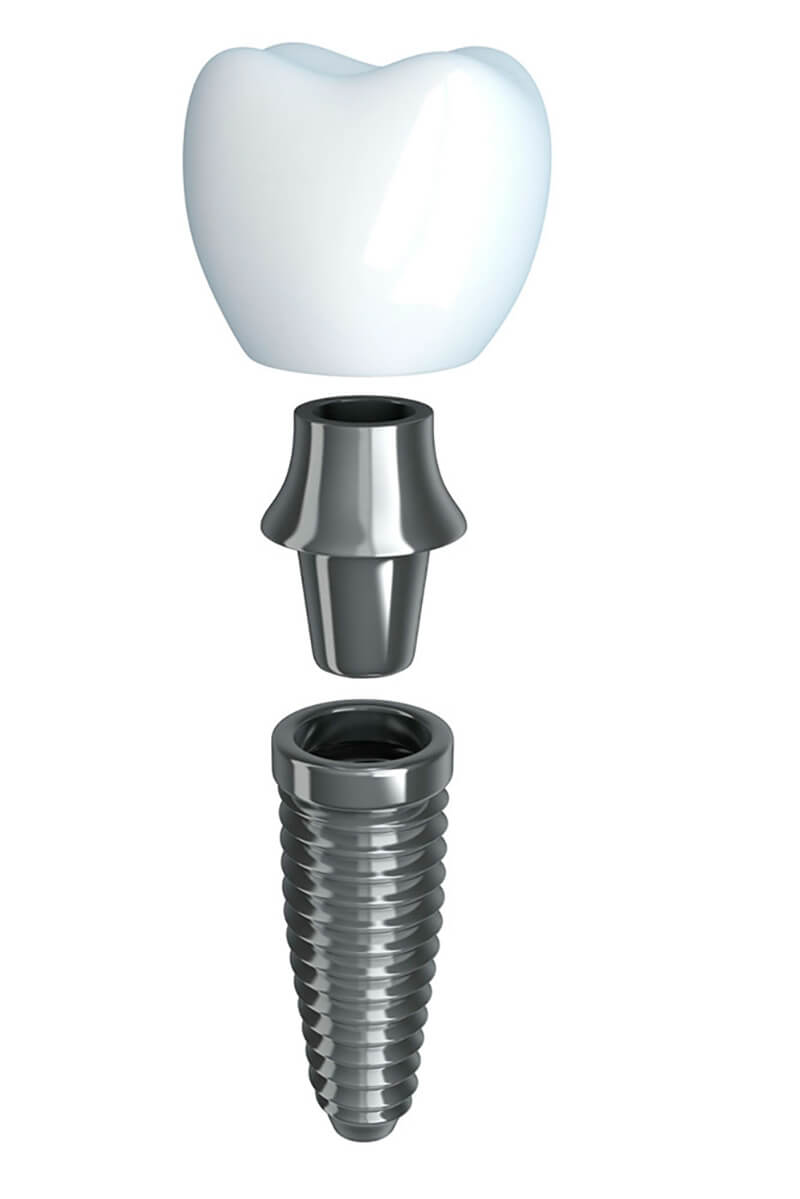 implant two phases
