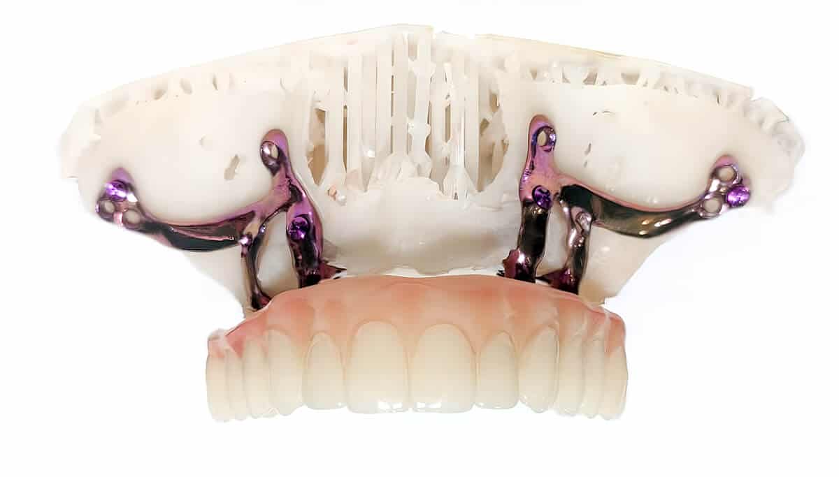 Implantes subperiósticos