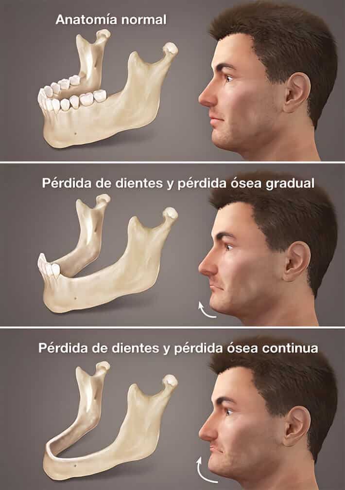 dental pieces