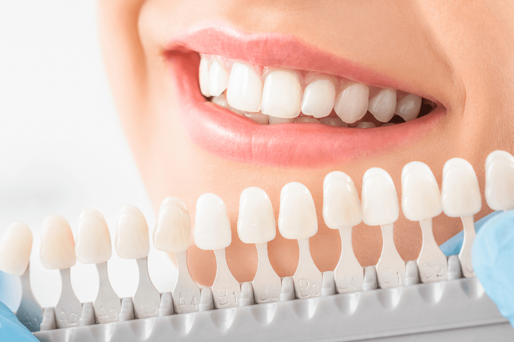 Prueba de color para carillas dentales en Costa Rica, clínica Sonrisa Para Todos