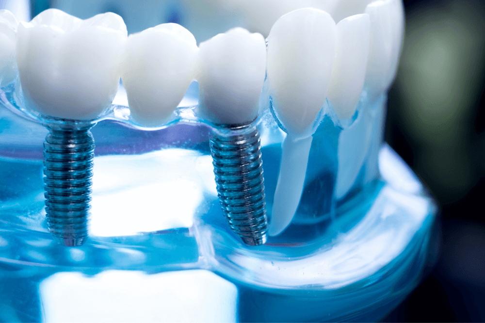 Dental bridges replace missing teeth