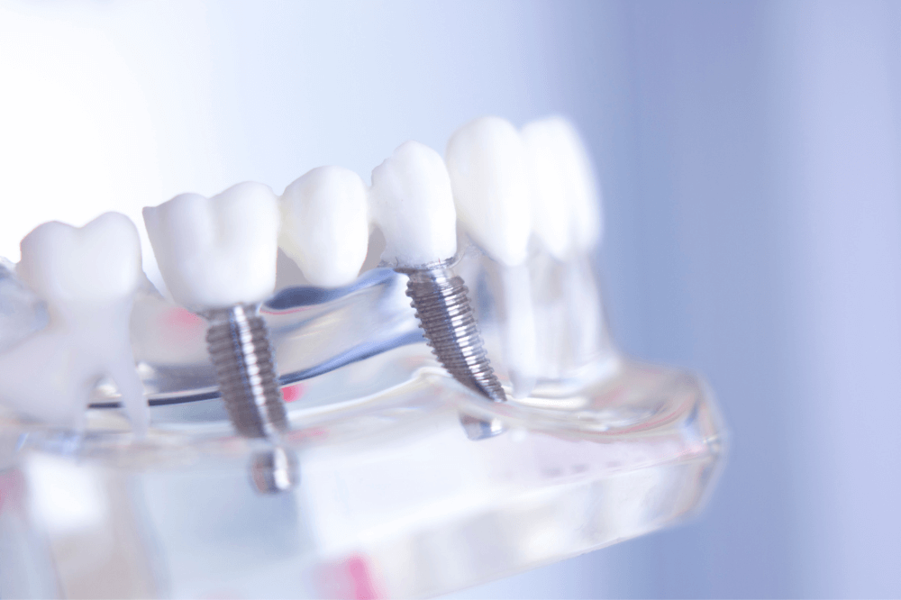 Replace teeth with a dental bridge