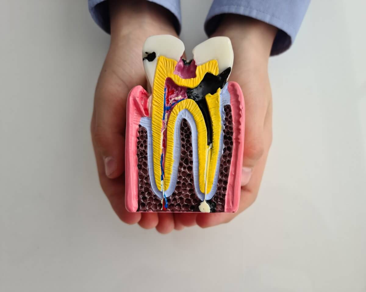 caries