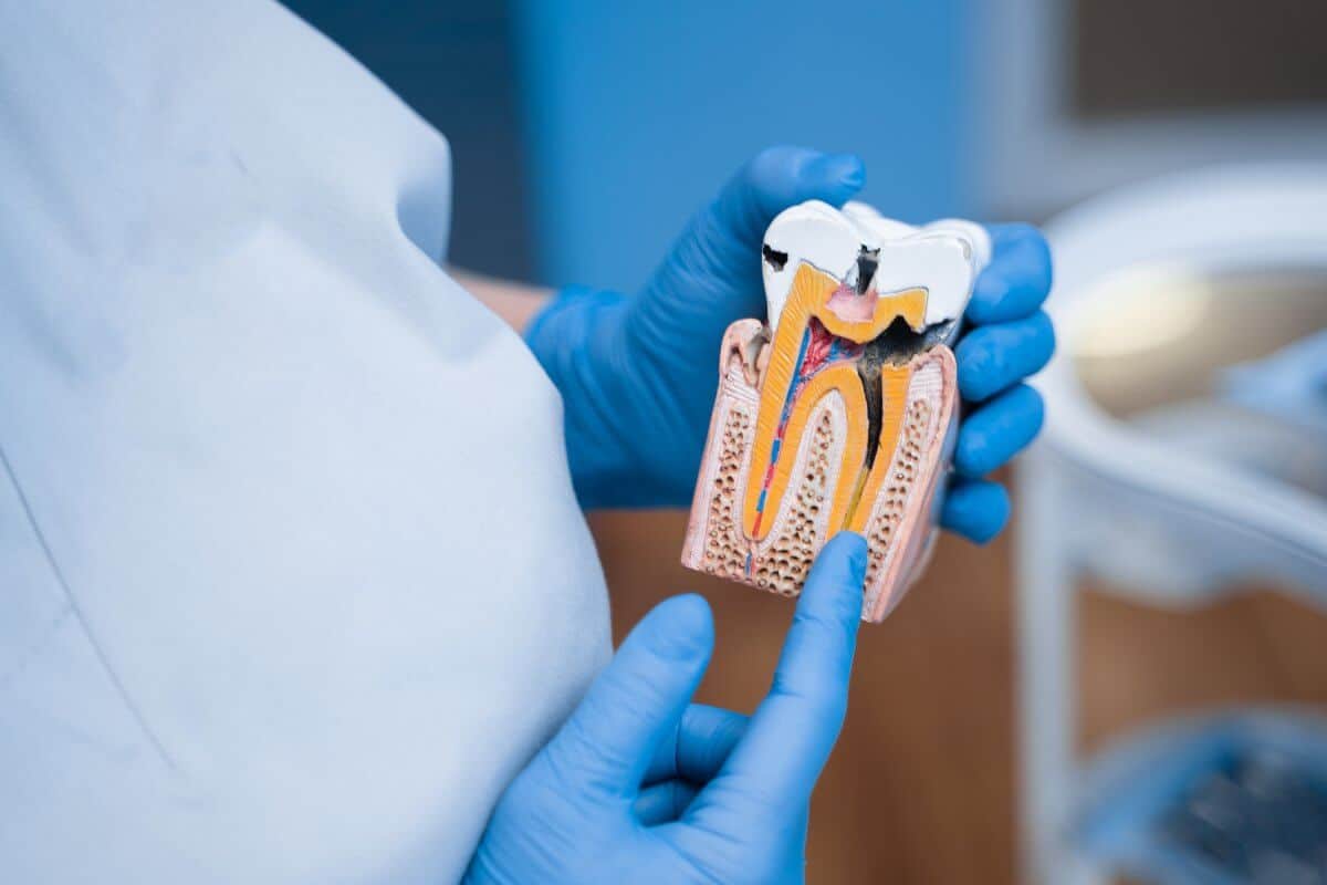 caries