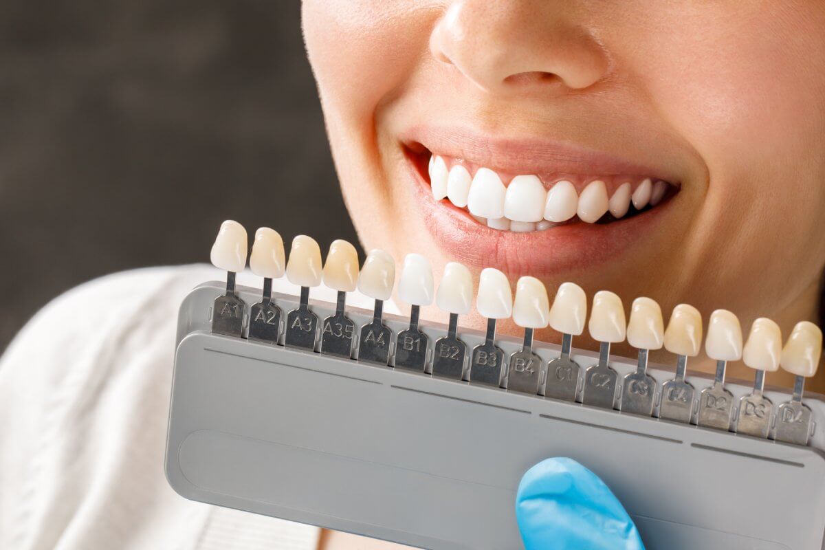 dental veneers