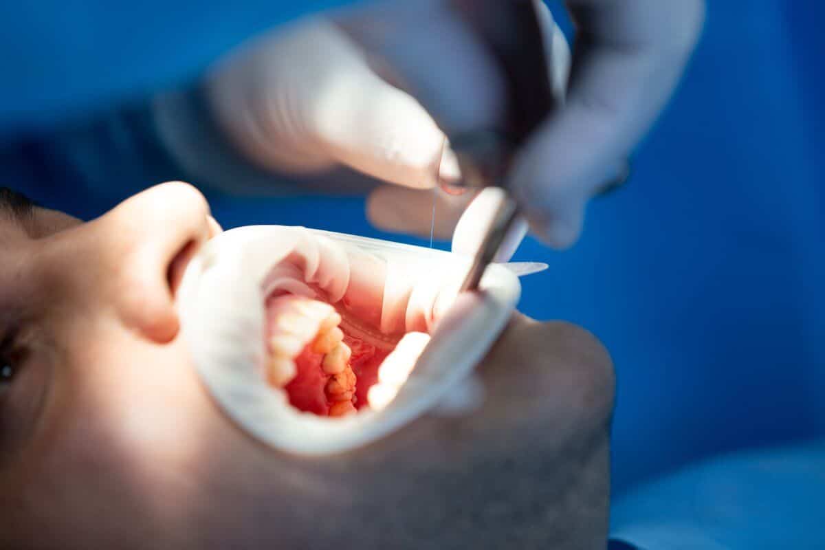 Dental Crowns in Costa Rica