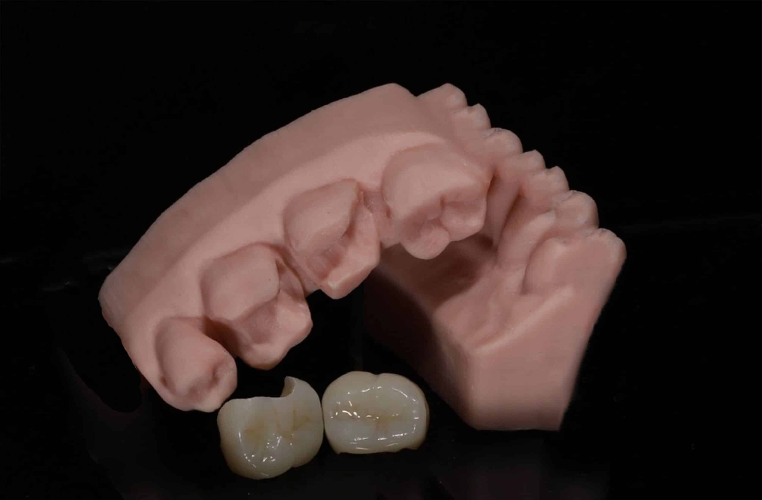 dental inlays in Costa Rica