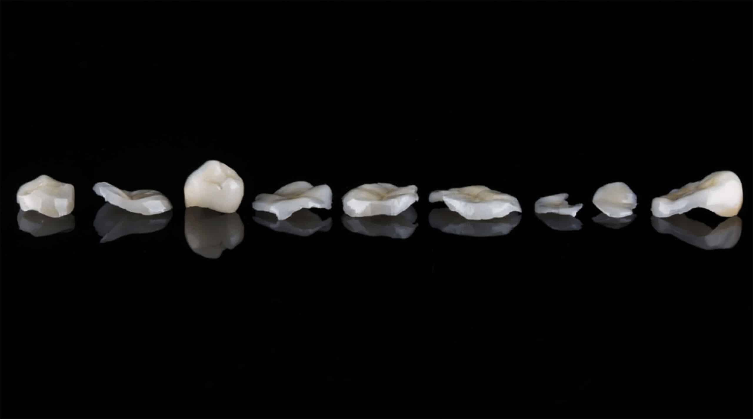 dental inlays in Costa Rica