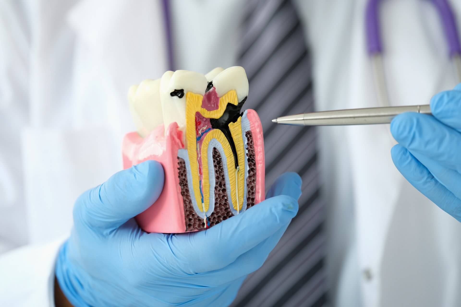 Tratamiento de endodoncia en Sonrisa Para Todos Costa Rica