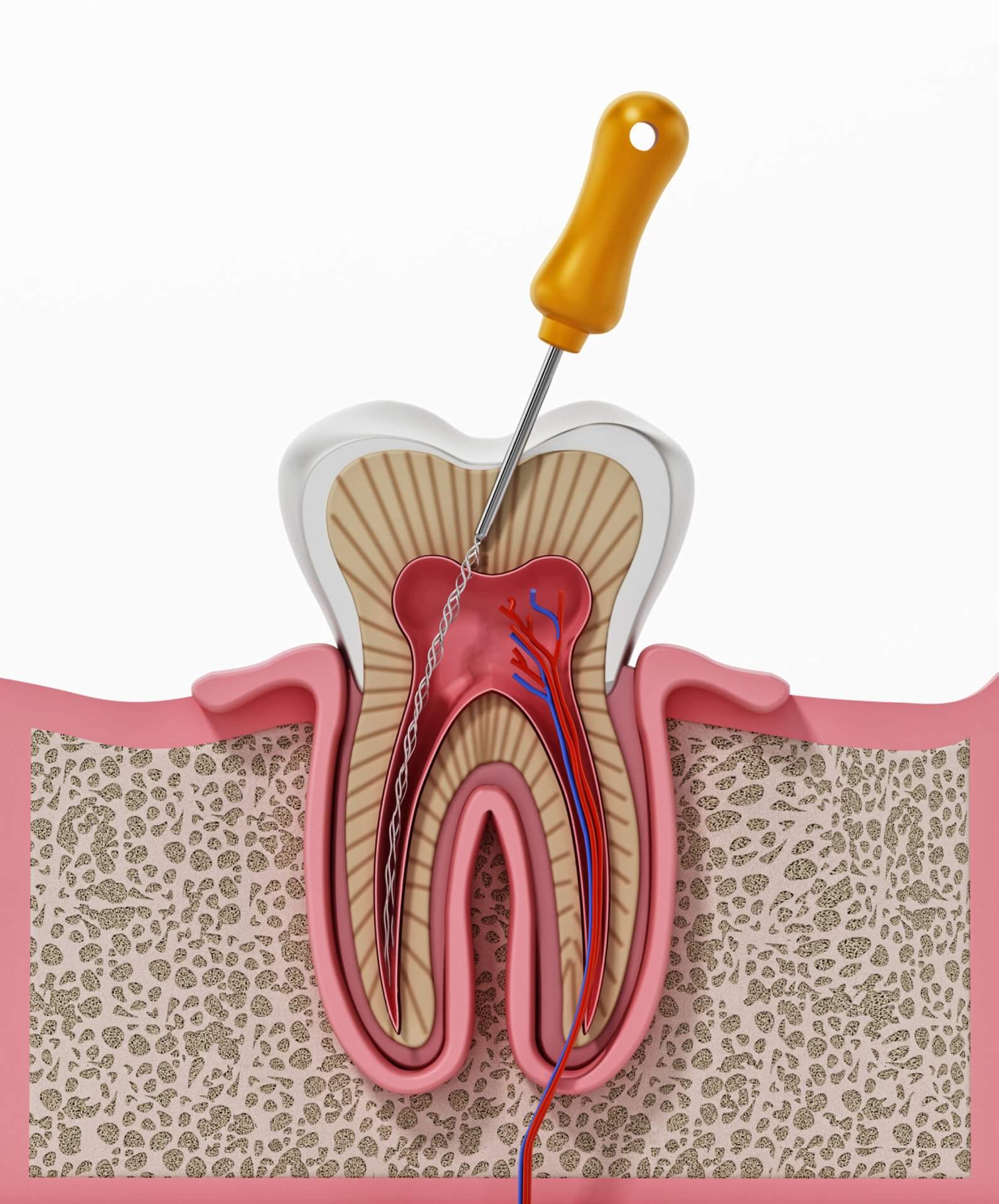 Beneficios de la endodoncia frente a la extracción - Sonrisa Para Todos