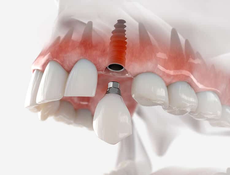 Implante dental - Sonrisa Para Todos