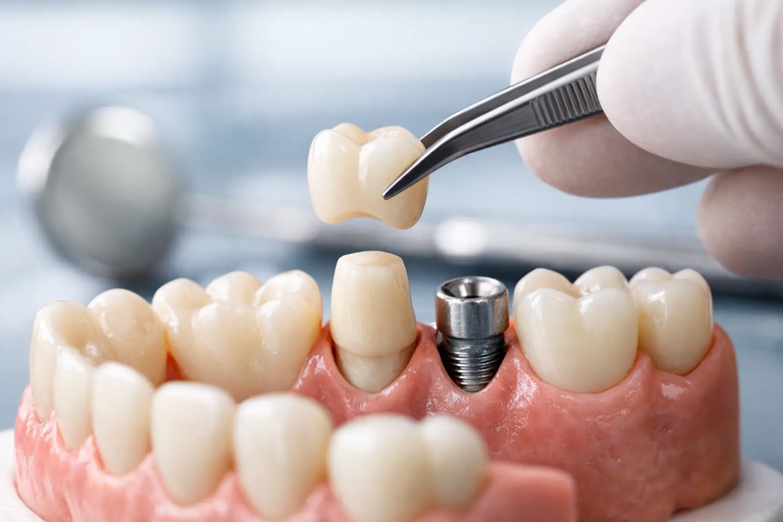 Cuándo necesito una corona dental