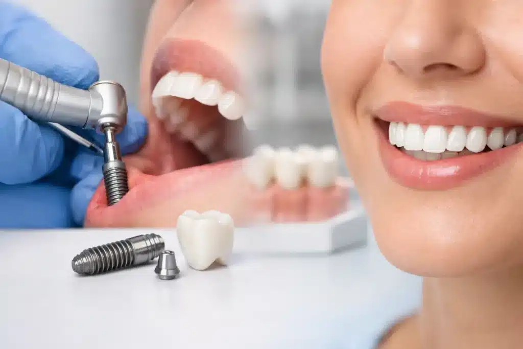 Cómo se coloca un implante dental paso a paso