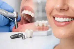 Cómo se coloca un implante dental paso a paso