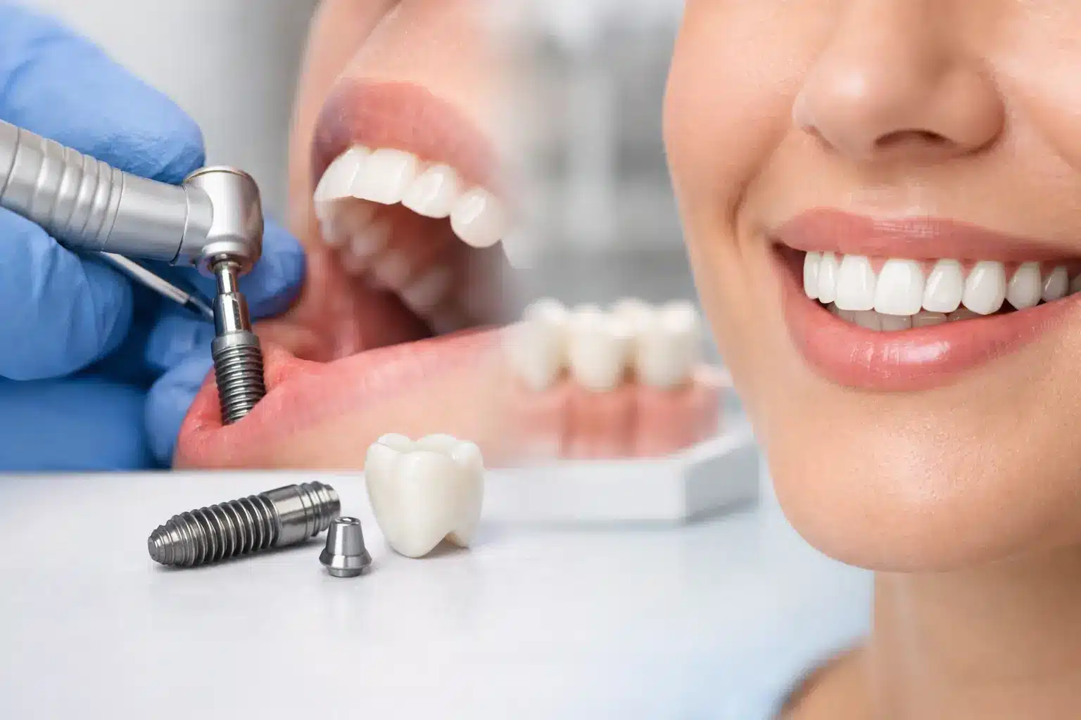 Cómo se coloca un implante dental paso a paso