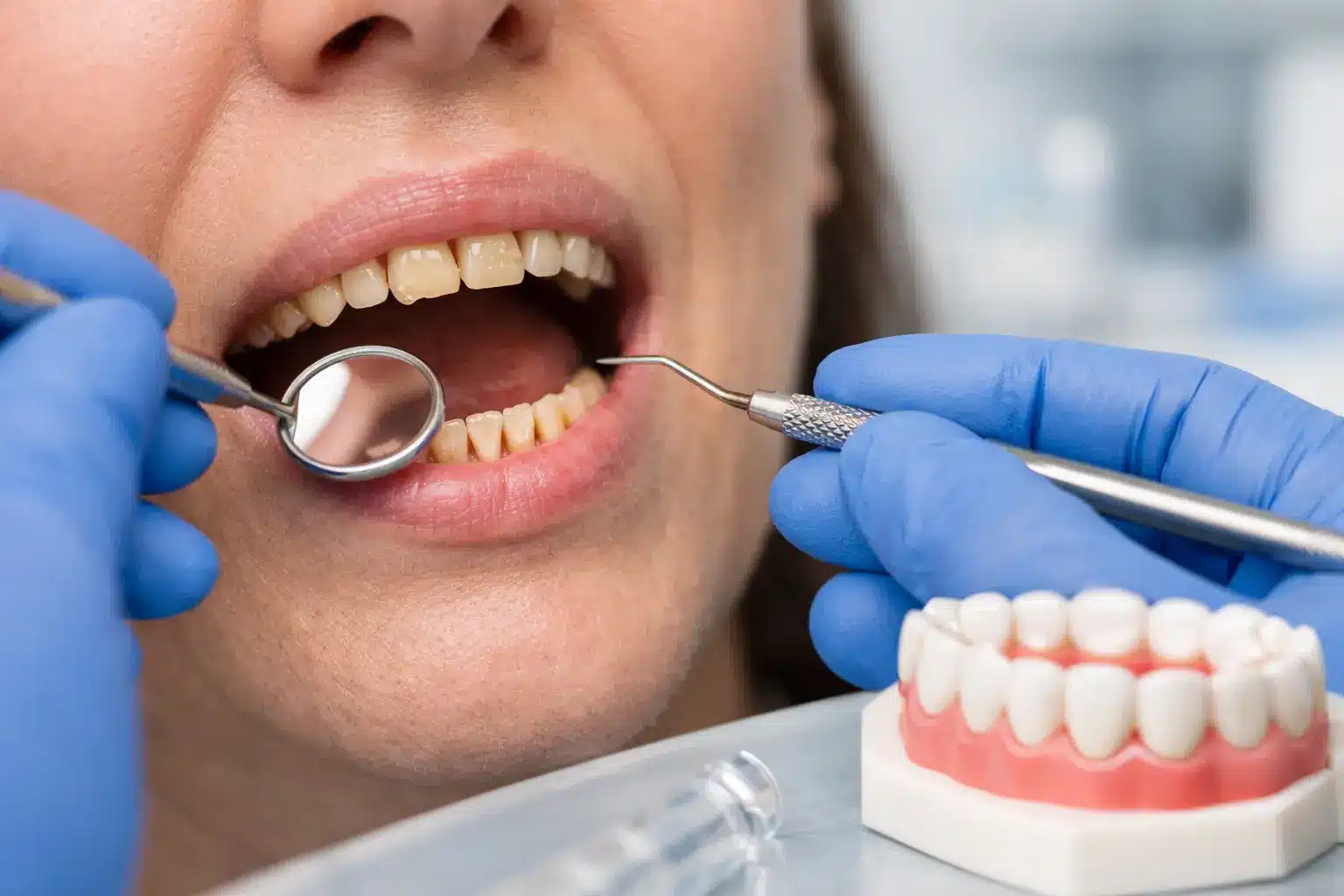 Cómo tratar el desgaste dental severo a tiempo