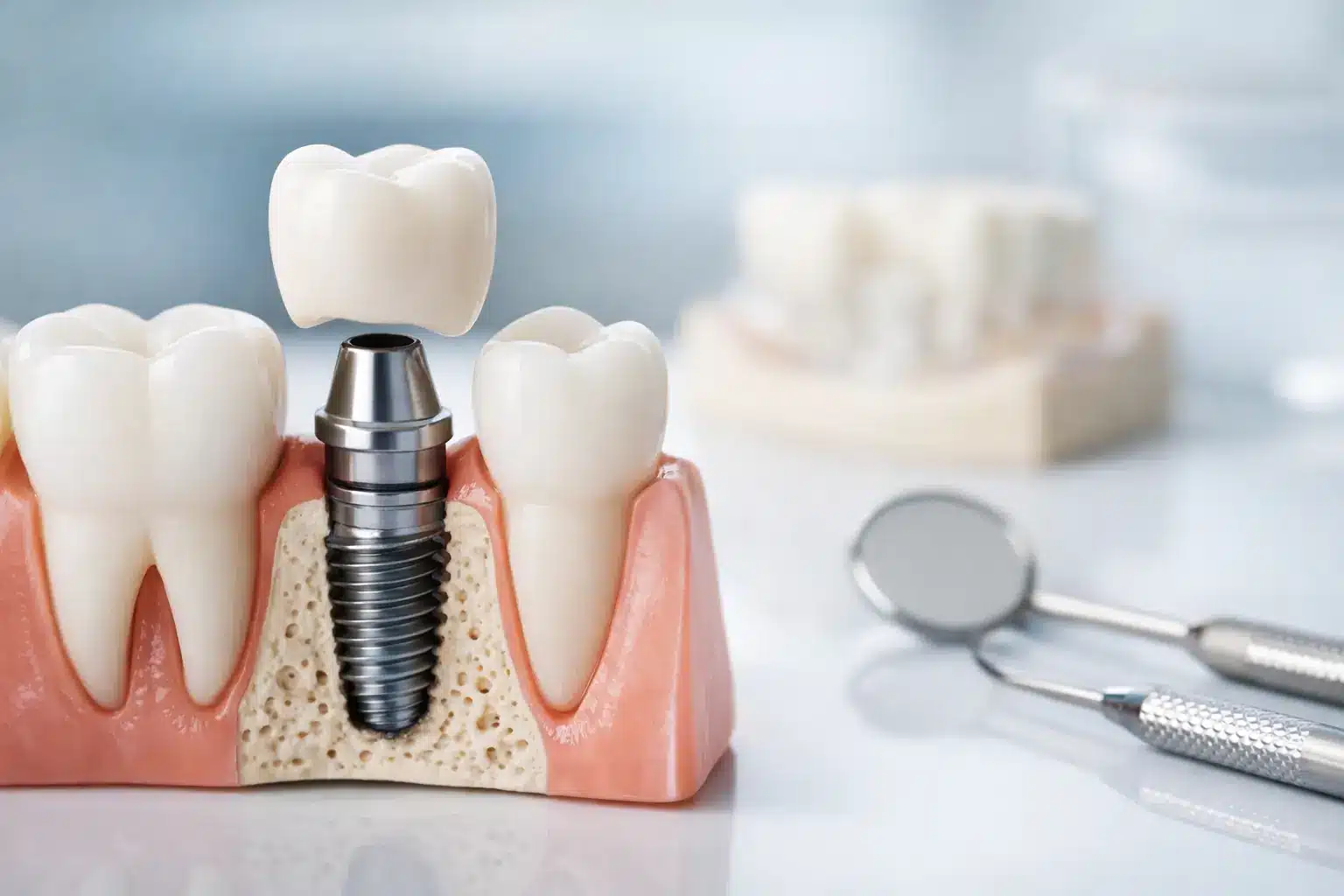 Guía de coronas sobre implantes dentales