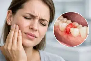 Muelas del juicio inflamadas y qué hacer