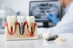 Solución para pérdida ósea dental eficaz