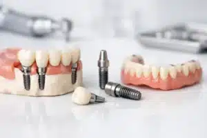 Guía para prótesis sobre implantes dentales
