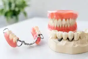 Prótesis removible versus fija ¿cuál conviene?