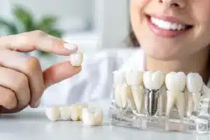 Opinión sobre coronas de zirconia y sus resultados